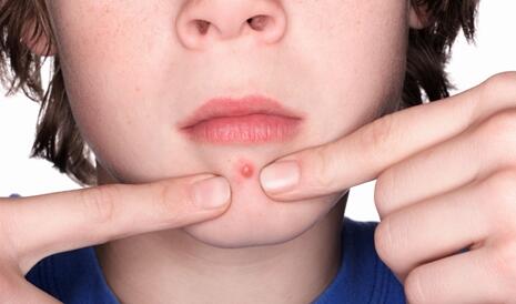 痘肌化妝有方法