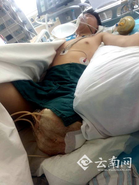 云南三兄妹同時被鋼筋戳翻 老大截肢妹妹肝肺破裂 云南三兄妹同時被鋼筋戳翻 老大截肢妹妹肝肺破裂