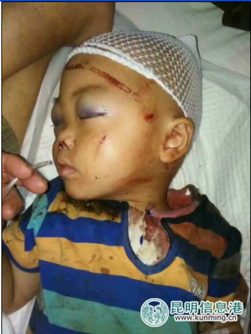 三歲男童家中玩耍被倒塌的鐵門框砸中受重傷