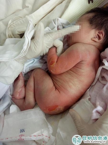 被燙傷的孩子。家屬供圖