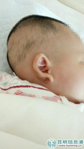 孩子右耳稍顯變形。家屬供圖