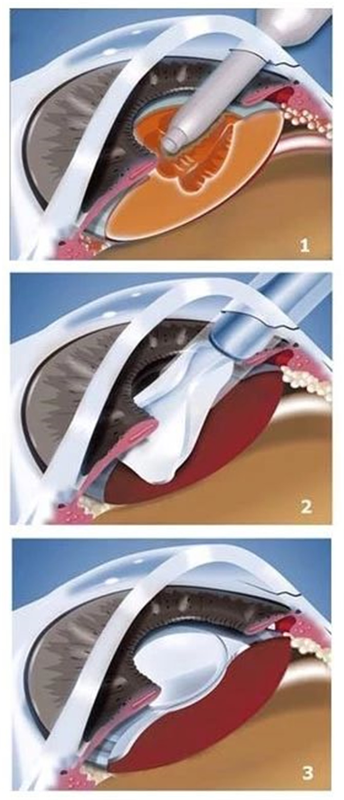 三焦點(diǎn)人工晶狀體植入術(shù)示意圖
