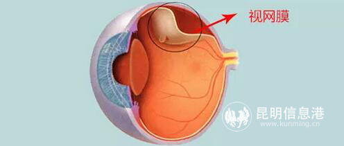 視網(wǎng)膜脫離 視網(wǎng)膜脫離