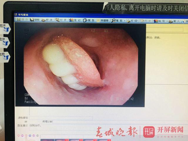 老人吃香蕉誤吞假牙