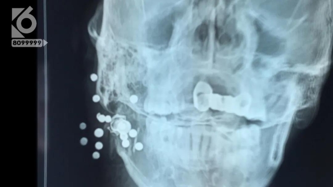 男子臉部被射15.5顆鋼珠，竟說是“自己走火”？