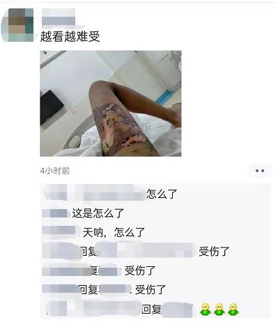麗江一男子買了手機才6天，手機便發(fā)生爆炸燒傷大腿？