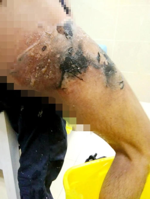 麗江一男子買了手機才6天，手機便發(fā)生爆炸燒傷大腿？