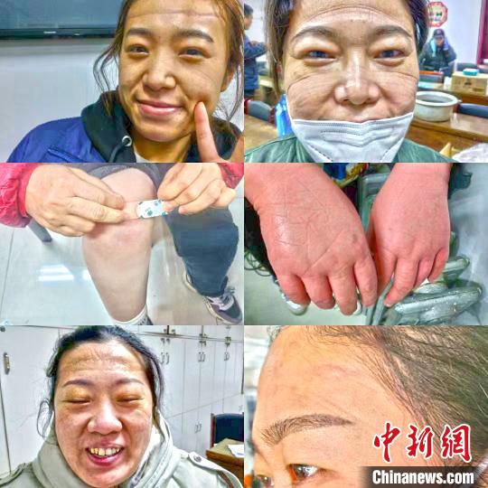 核酸采樣手“凍成饅頭”，這些醫(yī)護(hù)人員說……