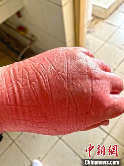 醫(yī)療隊員被凍傷的手。圖片由陸軍軍醫(yī)大學(xué)士官學(xué)校附屬醫(yī)院提供