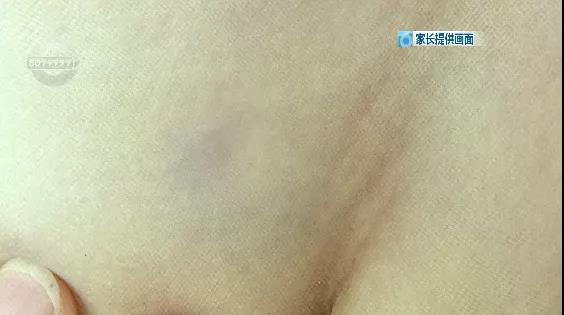 只因吃飯慢，5歲男童被老師踢傷？