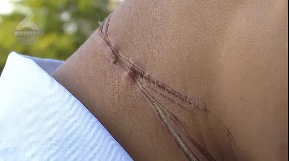 外賣小哥騎車被風(fēng)箏線“割喉”！