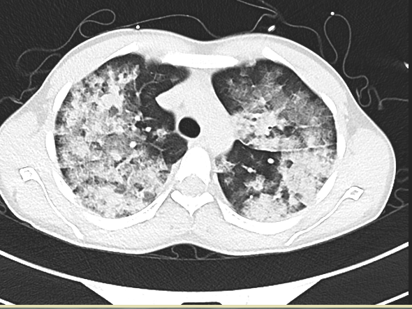 出現(xiàn)高反休息下就好了？當(dāng)心危及生命?。ù罄泶髮W(xué)第一附屬醫(yī)院供圖）